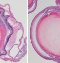 Treatment with a drug against a protein called ARF6 inhibits formation of eye tumors in mice. (Left) Without treatment, large tumors form (purple expansion surrounding the eye, stained pink). (Right) With treatment, tumors either do not form or are significantly smaller in size.