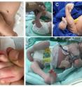 Figure 1 shows clinical pictures of children with arthrogryposis.