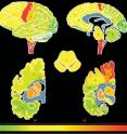 Whole-brain density map of TDP-43 distribution throughout central nervous system of ALS patients. Red, orange, and yellow depict areas of highest density of TDP-43 pathology.