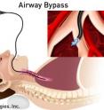 Airway bypass procedure uses stents to create new pathways for air in the diseased lung.