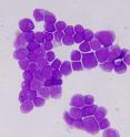 Acute myelogenous leukemia cells.