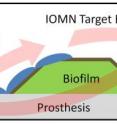 Iron-oxide nanoparticles developed at Brown University target an infected prosthesis, penetrate a bacterial film on the implant’s surface and thwart the colony by killing the bacteria. The nanoparticles also are believed to help natural bone cell growth.