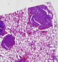 This is a section of lung tissue from a double knockout mouse, stained to show lung tumors. Mice lacking both the neil1 and nth1 genes were particularly prone to pulmonary and liver tumors during their second year.