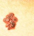 Scientists are reporting development and testing of a potential new material for diagnosing malignant melanoma, the most serious form of skin cancer. Shown is an image of melanoma on a patient’s skin.