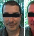 The side effects of nicotinic acid are harmless but clearly visible and felt by the patient. For this reason, the drug for increasing HDL cholesterol levels is not popular among patients. This could now change, thanks to the new discovery.