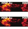 On top are photoacoustic images taken for gold nanorods (left), the new UW particle that has a magnetic core and surrounding gold shell (center), and a simple magnetic nanoparticle (right). Below is the same image after processing to remove pixels not vibrating with the magnetic field. The center blob is retained because of the particles' magnetic core and is bright because of the particles' gold shell. On top are photoacoustic images taken for gold nanorods (left), the new UW particle that has a magnetic core and surrounding gold shell (center), and a simple magnetic nanoparticle (right). Below is the same image after processing to remove pixels not vibrating with the magnetic field. The center blob is retained because of the particles' magnetic core and is bright because of the particles' gold shell.