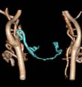 This is a CT angiography after face transplantation.
The recipient's left lingual artery was ligated, but the portion distal to the ligation (rectangular area) was still enhanced via blood flow from the contralateral side (arrow).