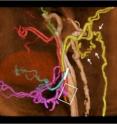 This is a CT angiography after face transplantation.
The donor's external carotid artery (pink) was successfully anastomosed to the recipient's vessel (rectangular area). Branches distal to the ligation (white line) receive blood flow from collateral vessels (arrows).