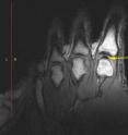 Static images revealed normal metacarpophalangeal joints with the expected lack of any gaseous cavity prior to joint distraction [Figure 2]. Following the cracking event, static imaging with the addition of MCP distraction yielded a dark intra-articular void [Figure 2].)
