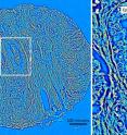 Left: Quantitative phase image of an unstained prostatectomy sample from a patient who had a biochemical recurrence of prostate cancer. Right: A zoomed-in region from the quantitative phase image showing a cancerous gland with debris in the lumen. The stroma, or supportive tissue environment, shows discontinuities in the fiber length and disorganization in the orientation of the fibers.