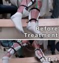 This image shows the range of voluntary movement prior to receiving stimulation compared to movement after receiving stimulation, physical conditioning, and buspirone. The subject's legs are supported so that they can move without resistance from gravity. The electrodes on the legs are used for recording muscle activity.