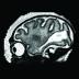 This is a magnetic resonance image (MRI) of the fetal brain in a Zika virus infected primate. The large white region is abnormal and indicates an accumulation of fluid in the brain.
